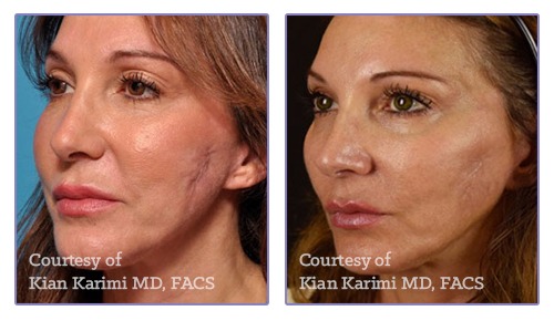 CosmoPen Before & After