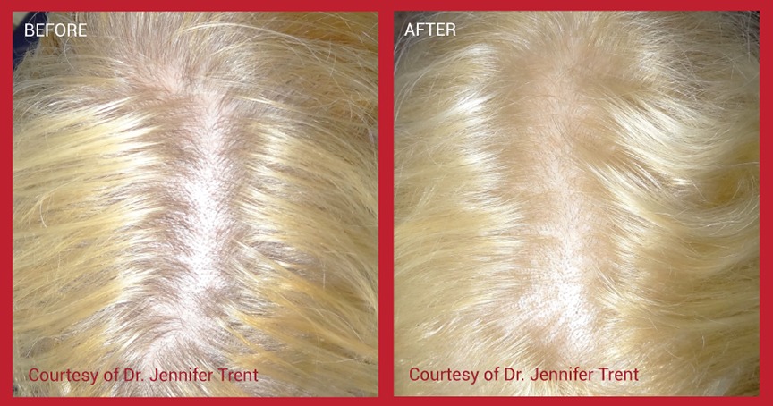 ezPRF Before & After
