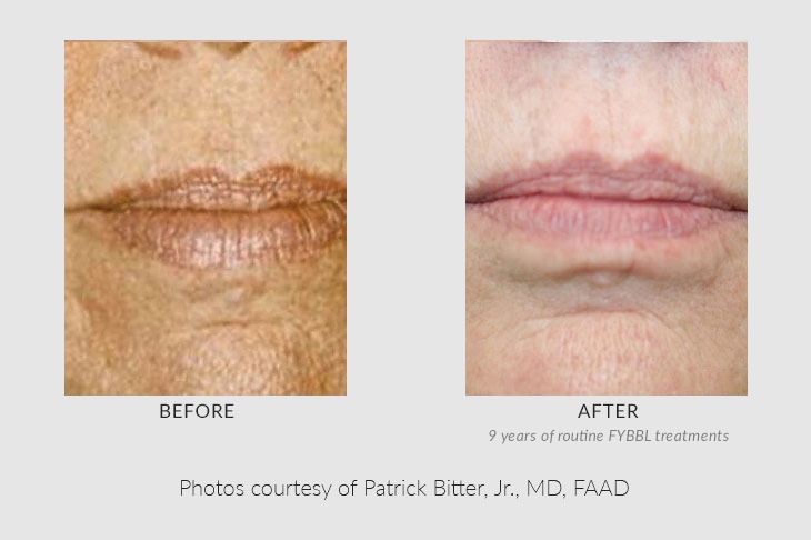 BBL Laser Before & After